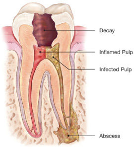 Root Canal at Bloor Dental Health Centre in Annex Toronto near Spadina station