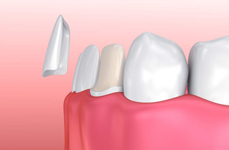 Cosmetic Dentistry Bloor, Dental Veneers Toronto Dentist Bloor Dental Health