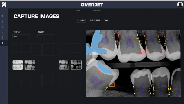 overjet-iris-denti-ai-comparison